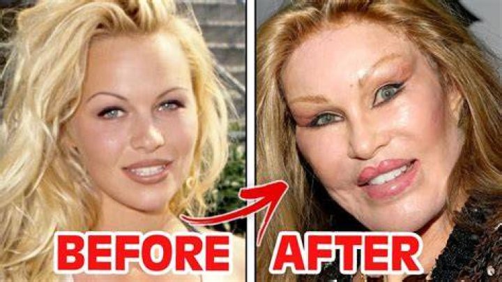 Not Eating Or Sleeping After Plastic Surgery – Hollywood Life